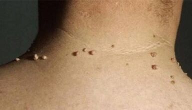 Giza gorputzean papilomak agertzeko arrazoiak