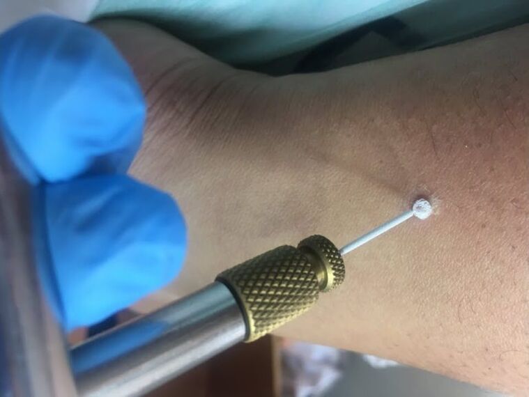 garatxoak kentzeko moduak