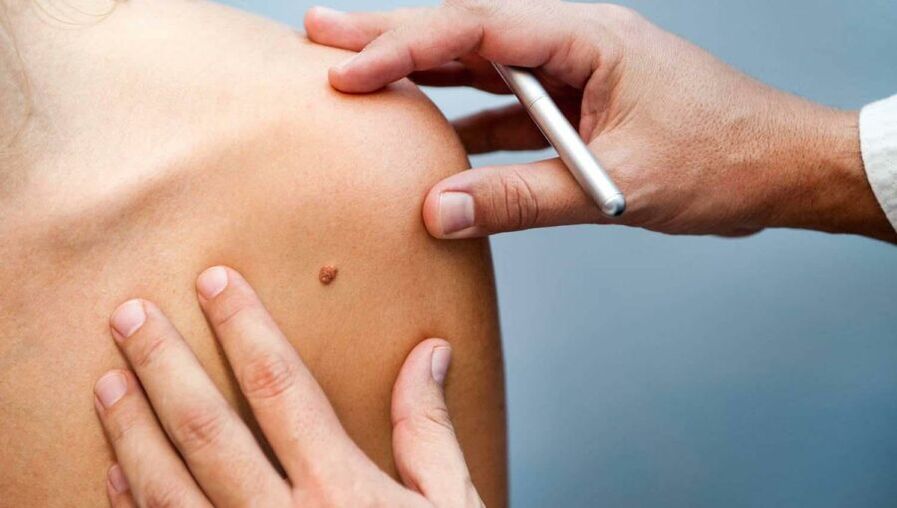 Dermatologoa papiloma duen paziente bat aztertzen