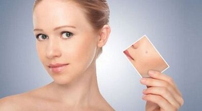 garatxoen eta papilomaren aurkako erremedio eraginkorren berrikuspena