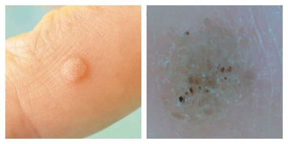 Berri arrunta azterketa eta dermatoskopian zehar