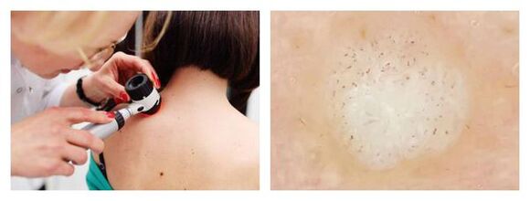 Wart-en dermatoskopia
